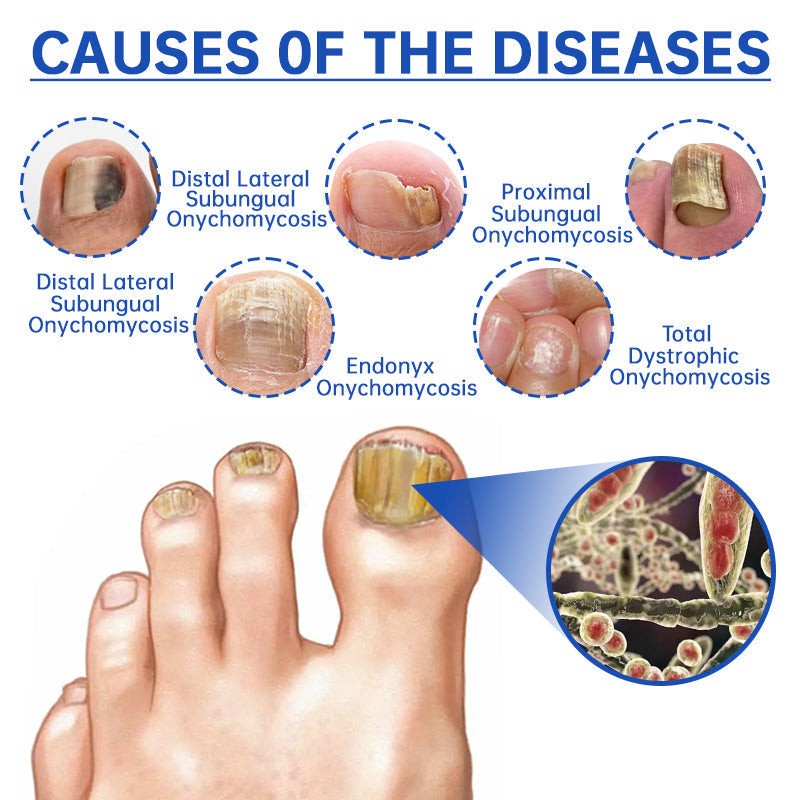 PureNail Fungus Laser Therapy Device Pro – Wisely Walrus