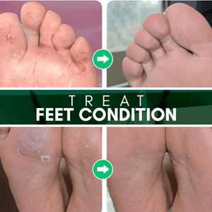 Anti-Fungal Toe Spray